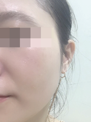 K5 LIPOGEL / KEM TRỊ NÁM, TÀN NHANG, TĂNG SẮC TỐ