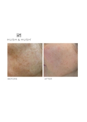 HUSH & HUSH SkinCapsule BRIGHTEN +/ VIÊN UỐNG SÁNG DA VÀ MỜ THÂM NÁM