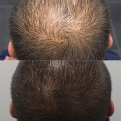 DERMICA HairZon – Tinh Chất Dưỡng Tóc Giải Pháp Hỗ Trợ Giảm Rụng Tóc, Kích Thích Tóc Trông Dày Và Bồng Bềnh Hơn
