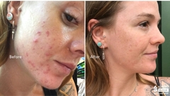PHARMAFORM EXFOL MULTI-ACID PEEL: Peel Da Đa Tầng – Tái Tạo, Cải Thiện Nếp Nhăn & Giảm Mụn