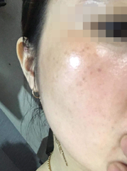 K5 LIPOGEL / KEM TRỊ NÁM, TÀN NHANG, TĂNG SẮC TỐ