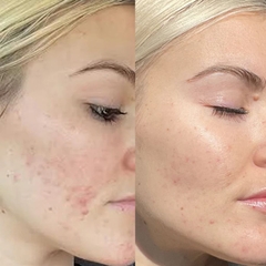 NEOVA CELL RENEWAL – (Alpha-Beta-Retinol) / SERUM TÁI TẠO TẾ BÀO, HỖ TRỢ THIẾU HỤT COLLAGEN, STRESS OXY HÓA, KIỂM SOÁT PHẢN ỨNG VIÊM