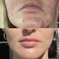 NEOVA MICROFOLIANT CLEANSER (Alpha-Beta-Retinol) / SỮA RỬA MẶT TẨY TẾ BÀO CHẾT, LÀM SẠCH LỖ CHÂN LÔNG