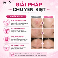 Deriva-BPO Gel: Giải Pháp Giảm Mụn Trứng Cá, Kháng Viêm Và Giải Phóng Lỗ Chân Lông