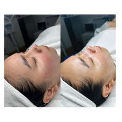 RESURFACE²: Liệu Trình Peel Tái Tạo Tế Bào & Trẻ Hóa Chuyên Sâu Từ Ý