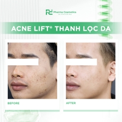 ACNE LIFT® THANH LỌC DA: Chấm Dứt Tình Trạng Bít Tắc và Mụn Ẩn