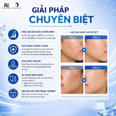 Differin Adapalene Gel 0.1%: Giải Pháp Trị Mụn Retinoid Chuẩn Y Khoa Cho Làn Da Sạch Mụn