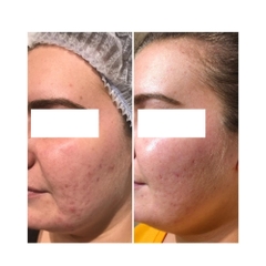 LIỆU PHÁP GROWTH FACTOR MICRONEEDLING: Giải Pháp Toàn Diện Cho Làn Da Sẹo Mụn, Lão Hóa, Thâm Nám