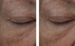 SKINBETTER INTERFUSE TREATMENT CREAM EYE / KEM MẮT GIẢM NHĂN, BỌNG VÀ THÂM