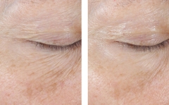 SKINBETTER INTERFUSE TREATMENT CREAM EYE / KEM MẮT GIẢM NHĂN, BỌNG VÀ THÂM