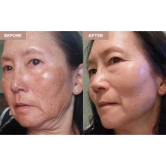 TRETINOIN CREAM, USP PADAGIS: Giải Pháp Chuyên Sâu Cho Mụn, Thâm & Lão Hóa Da
