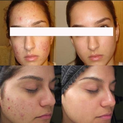 AZELDERM 20% KREM AZELAIC AICD 30g / KEM TRỊ MỤN, LÀM SÁNG VÀ ĐỀU MÀU DA
