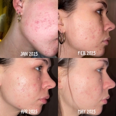 ADAPALENE GEL ADAFERIN 0.1%: Gel Đặc Trị Mụn Ẩn, Mụn Đầu Đen - Cho Làn Da Láng Mịn