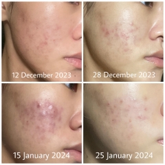 EZANIC GEL 20% AZELAIC ACID 15g / GEL TRỊ MỤN GIẢM THÂM