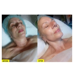 LIỆU PHÁP CO2 CARBOXY: Thanh Lọc Da Chuyên Sâu, Trẻ Hóa Không Xâm Lấn