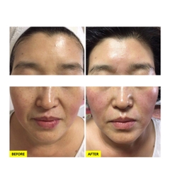 LIỆU PHÁP CO2 CARBOXY: Thanh Lọc Da Chuyên Sâu, Trẻ Hóa Không Xâm Lấn