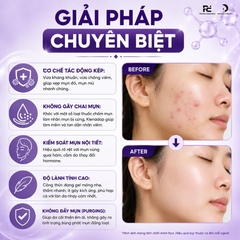 Klenadap 5% Dapsone Gel 15g - Giải Pháp Vàng Cho Mụn Nội Tiết & Mụn Viêm