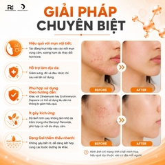 Klenadap 7.5% Dapsone – Gel Trị Mụn Giải Pháp Vàng Cho Mụn Nội Tiết Và Mụn Viêm