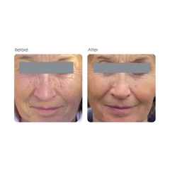 MD:COMPLEX GENX MIMETIC PEPTIDES & GROWTH FACTOR / MESO NHAU THAI GIÚP SỬA CHỮA & TÁI SINH LÀN DA