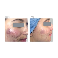 MD:COMPLEX SKINCLEAR CX / MESO TRỊ MỤN