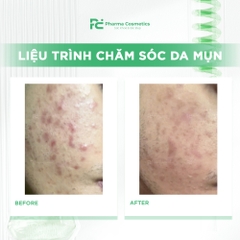 HISTOLAB LIỆU TRÌNH CHĂM SÓC DA MỤN CHUYÊN SÂU: Giải Pháp Thanh Lọc và Tái Tạo Làn Da Khỏe Mạnh