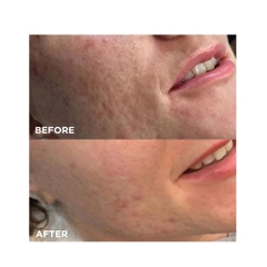 LIỆU PHÁP GROWTH FACTOR MICRONEEDLING: Giải Pháp Toàn Diện Cho Làn Da Sẹo Mụn, Lão Hóa, Thâm Nám