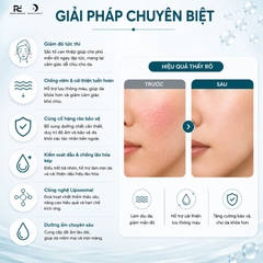 SESDERMA AZELAC MOISTURIZING FACIAL CREAM: Kem Dưỡng Đặc Trị Đỏ Da, Trứng Cá Đỏ & Lão Hóa