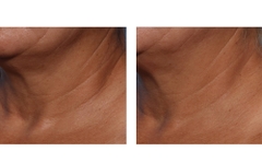 SKINBETTER TECHNO NECK PERFECTING CREAM / KEM DƯỠNG VÙNG DA CỔ VÀ NGỰC