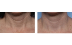 SKINBETTER TECHNO NECK PERFECTING CREAM / KEM DƯỠNG VÙNG DA CỔ VÀ NGỰC