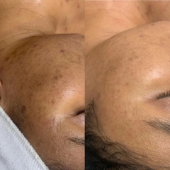 LIỆU PHÁP ENZYME THERAPY: Phục Hồi Làn Da "Không Dung Nạp Điều Trị