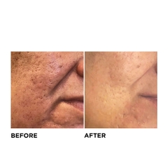 LIỆU PHÁP GROWTH FACTOR MICRONEEDLING: Giải Pháp Toàn Diện Cho Làn Da Sẹo Mụn, Lão Hóa, Thâm Nám