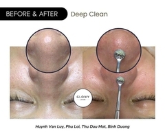 ANNA LOTAN HYDRATION GEL POWDER / BỘT Ủ MỤN