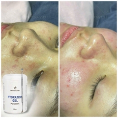 ANNA LOTAN HYDRATION GEL POWDER / BỘT Ủ MỤN