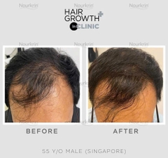 NOURKRIN HAIR GROWTH + IN CLINIC / VIÊN UỐNG MỌC TÓC