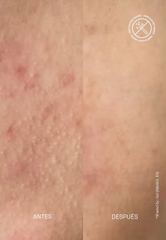 ACNEMY ZITMASK® ANTI-BLEMISH SULFUR MASK / MẶT NẠ MỤN SULFUR 