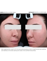 DERMEDEN BIOCELLULOSE: Mặt Nạ Cấp Ẩm & Phục Hồi Chuyên Sâu, Hạn Chế Tăng Sắc Tố Sau Liệu Trình