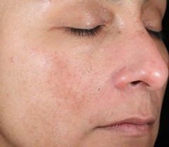 IS CLINICAL ACTIVE PEEL SYSTEM: Bộ Đôi Tái Tạo Da Chuyên Sâu, Cho Làn Da Căng Bóng & Mịn Màng