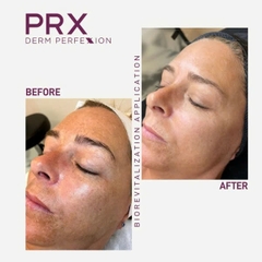 WiQo PRX-PLUS: Giải Pháp Trẻ Hoá Toàn Diện, Không Xâm Lấn