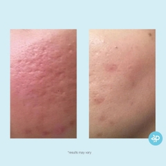 PERFECT IMAGE Lactic 50% Gel Peel: Thay Da Sinh Học Làm Sáng, Trẻ Hóa & Mờ Thâm Nám