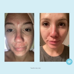 Perfect Image Glycolic 30% Gel Peel: Thay Da Sinh Học Trẻ Hóa, Làm Mịn Và Căng Bóng Da