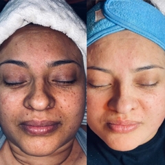 Perfect Image Glycolic 50% Gel Peel: Giải Pháp Thay Da Sinh Học Trẻ Hóa & Tái Tạo Bề Mặt Chuyên Sâu