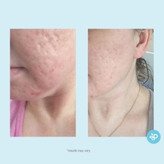 Perfect Image Glycolic 50% Gel Peel: Giải Pháp Thay Da Sinh Học Trẻ Hóa & Tái Tạo Bề Mặt Chuyên Sâu