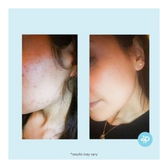 Perfect Image Salicylic 20% Gel Peel: Giải Pháp Thay Da Sinh Học Đặc Trị Mụn, Kiềm Dầu Và Se Khít Lỗ Chân Lông