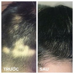 NOURKRIN HAIR GROWTH + IN CLINIC / VIÊN UỐNG MỌC TÓC