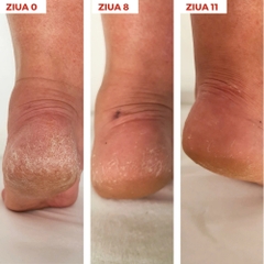 Synergy Therm Xerocare Anti-Callus Cream 40% Urea: Giải Pháp Đặc Trị Da Chai Sần Và Nứt Nẻ