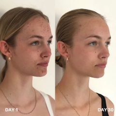 Clinisoothe+ Skin Purifier: Cuộc Cách Mạng Kháng Khuẩn Và Phục Hồi Da Đa Năng