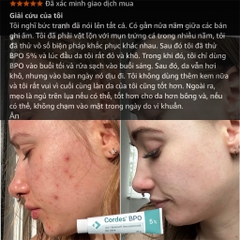 Cordes® BPO 5% Gel – Giải Pháp Đặc Trị Mụn Trứng Cá Cấp Độ Trung Bình
