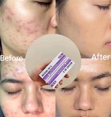 Benzac AC 5 (5%) Gel – Gel Dưỡng Hỗ Trợ Làm Giảm Mụn Viêm, Kiểm Soát Bã Nhờn Và Làm Dịu Da