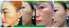 Melasma Green 21 Hỗ trợ trị nám hiệu quả công nghệ thủy phân đa tầng sắc tố tiên tiến từ Nhật Bản