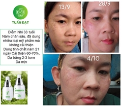 Melasma Green 21 Hỗ trợ trị nám hiệu quả công nghệ thủy phân đa tầng sắc tố tiên tiến từ Nhật Bản